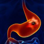 Gastrit nedir? Belirtileri, tedavisi, ilaçları ve diyeti