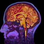 alzheimer hastalığı