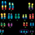 chromosome Intelligence boost for Down patients