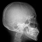 siyah kemik hastalığı