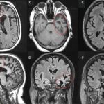 frontotemporal dementia