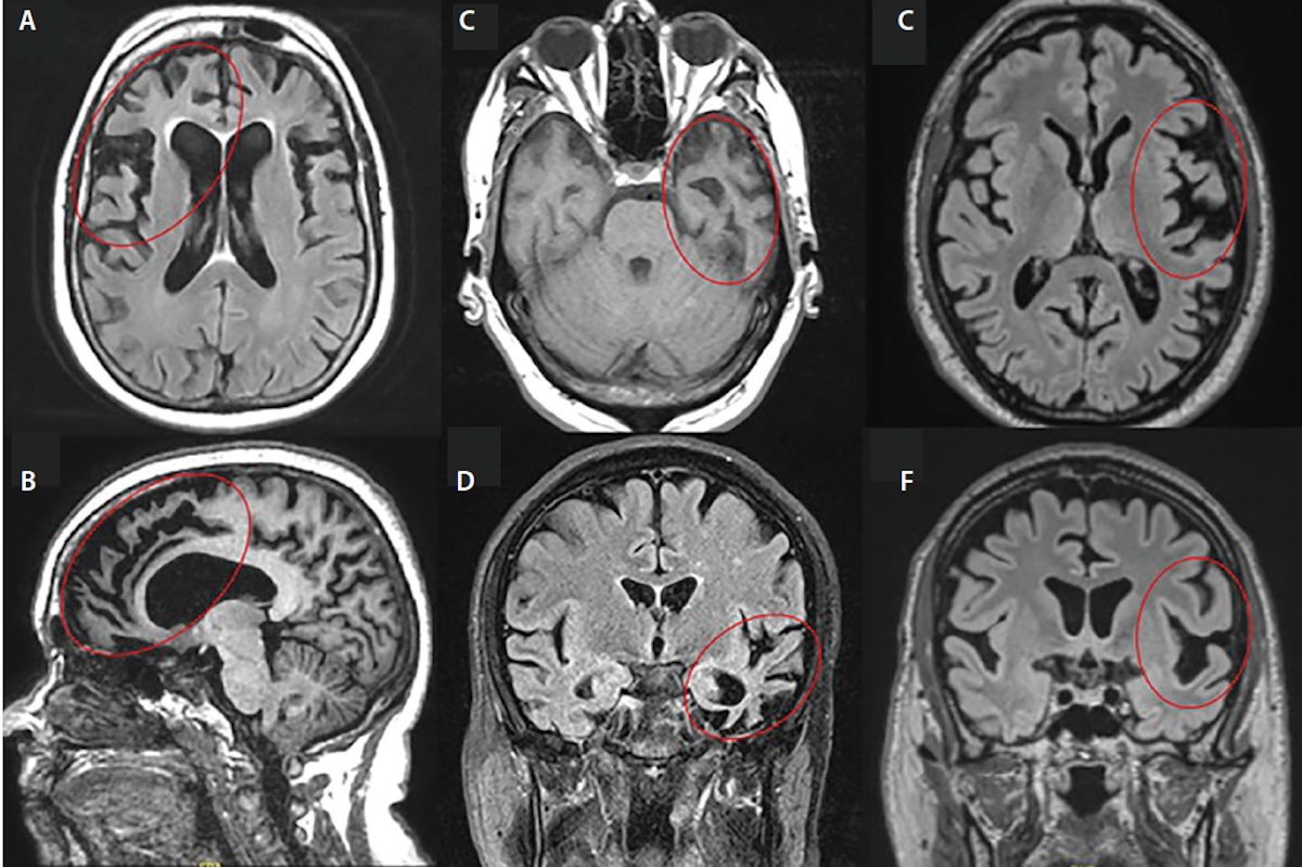 frontotemporal dementia