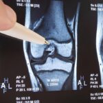 Osteoartritli bir dizin diyagramı