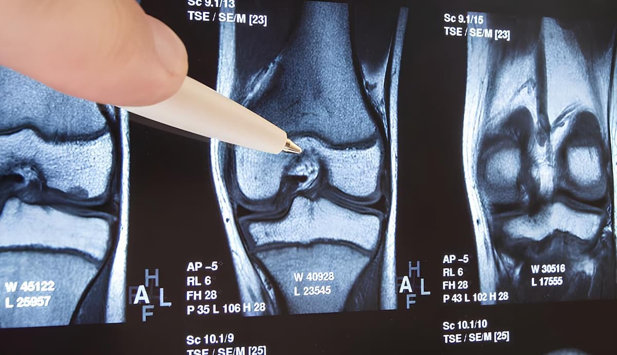 Osteoartrit Nedeniyle Aşınan Dizler İçin Burun Kıkırdağı Kullanılıyor