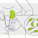 idrar yolu enfeksiyonu