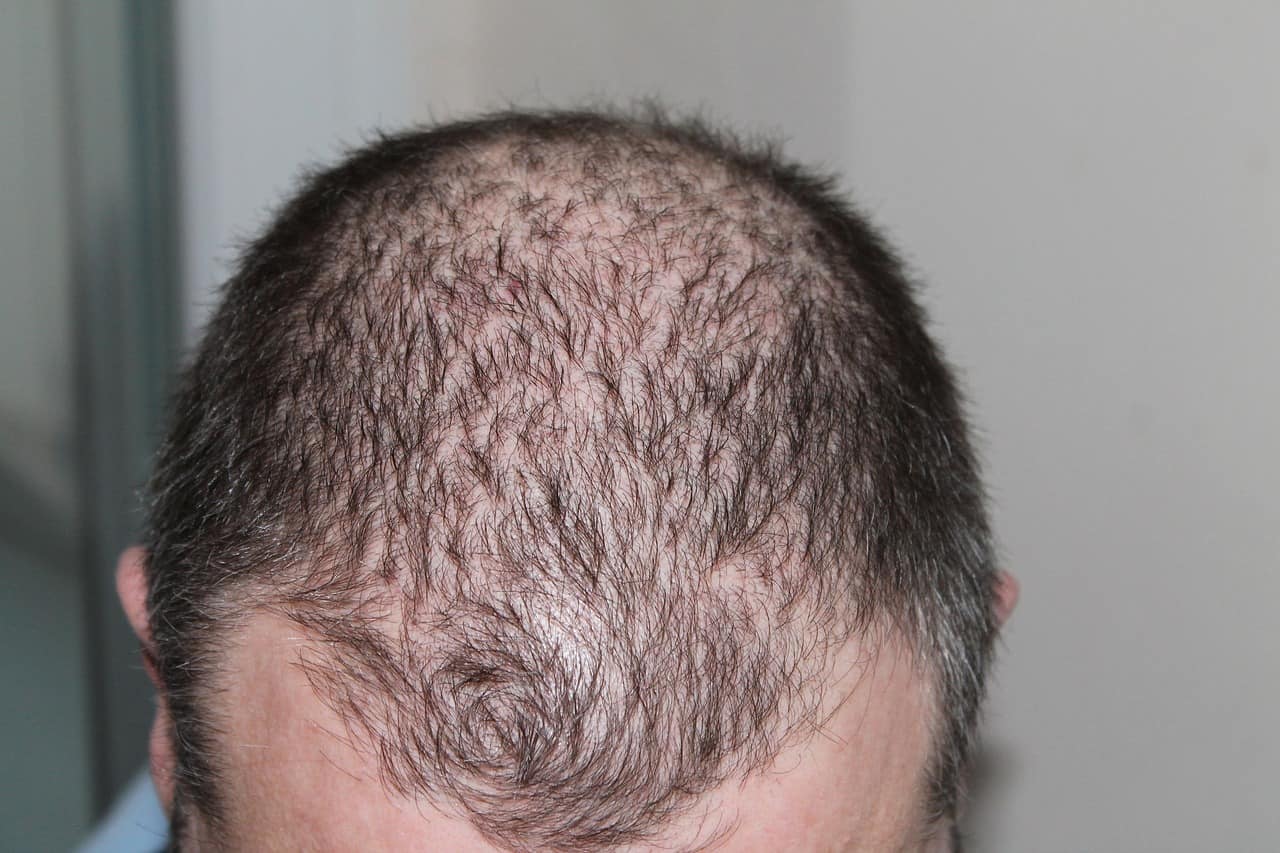 Saç Dökülmesinde Çığır Açan Buluş Keratin Mikrokürelerde Bulundu