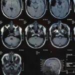 beyin kanseri taraması