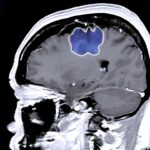 Bir hastanın beynindeki glioblastomun renkli BT taraması.