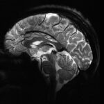 beyin mri